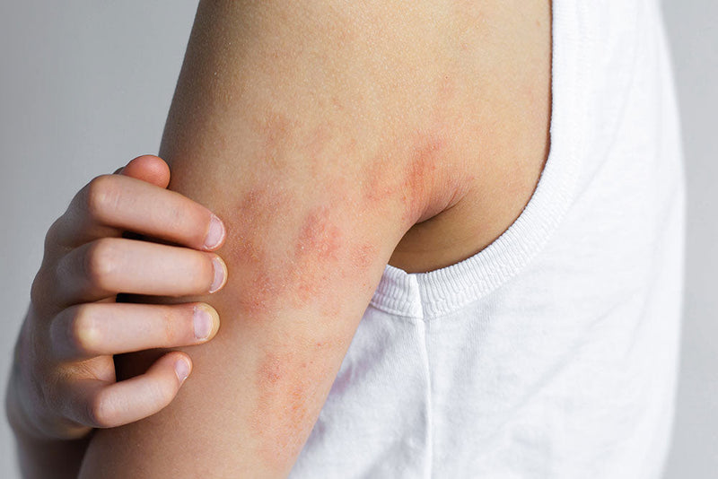 Schuppenflechte (Psoriasis): Ursachen, Symptome & Alltag