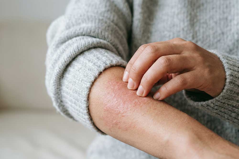 Kleidung bei Psoriasis: Materialien & Schnitte im Blick
